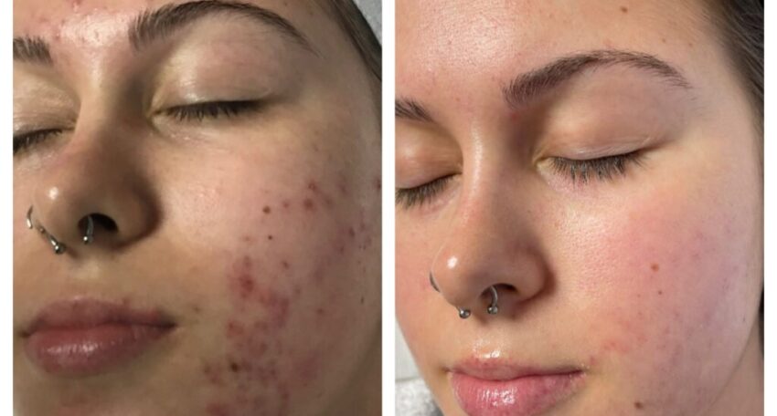Acne Treatment
