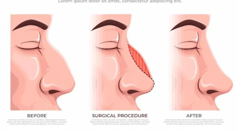 Rhinoplasty in Kuwait: