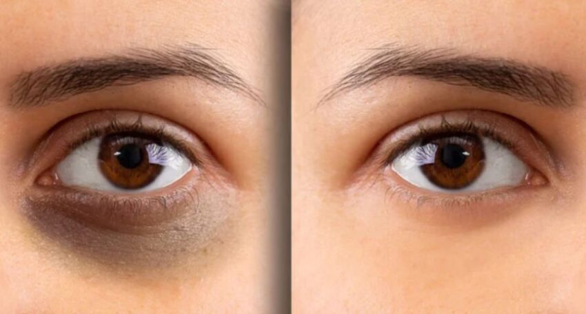 Dark Circles Treatment