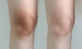 Laser Whitening for Knees and Elbows