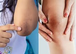 Laser Whitening for Knees and Elbows