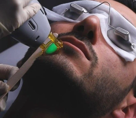 Laser Hair Removal